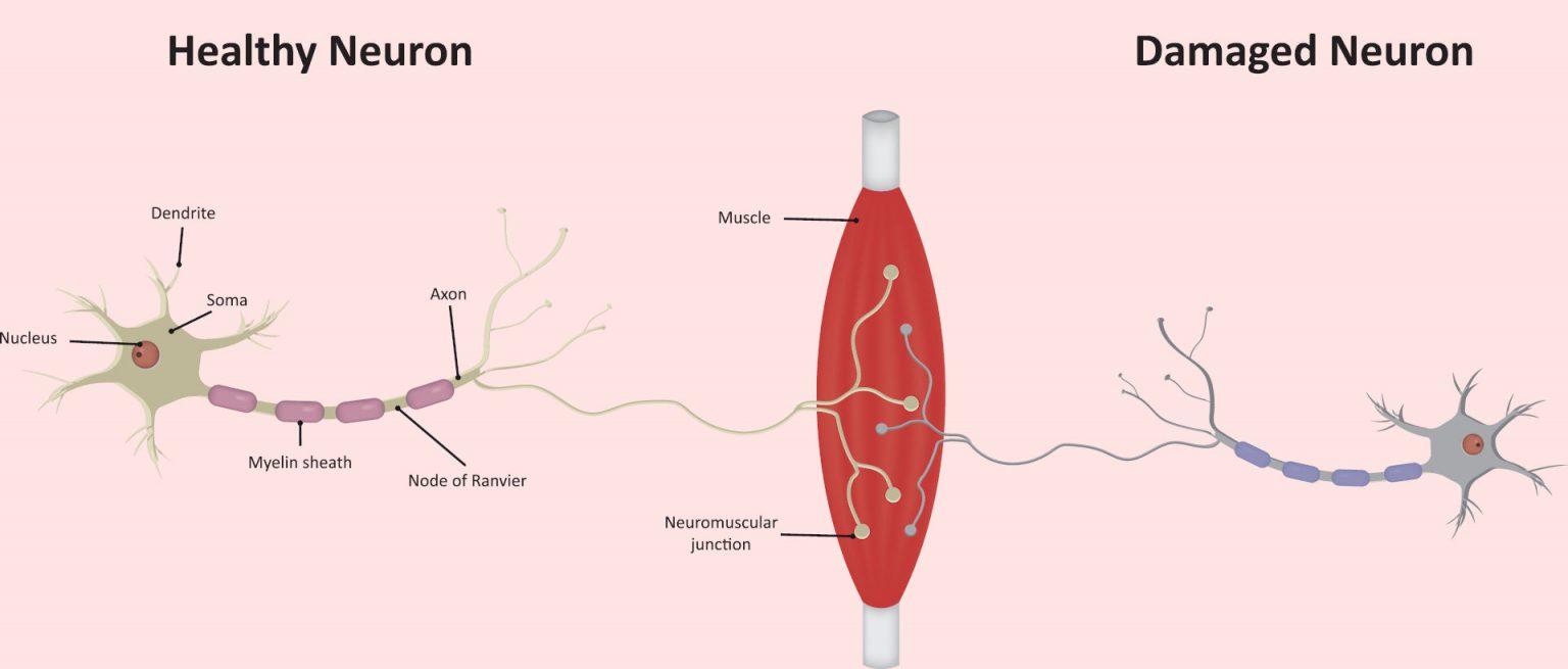 Motor Neuron Disease Total Health Physio